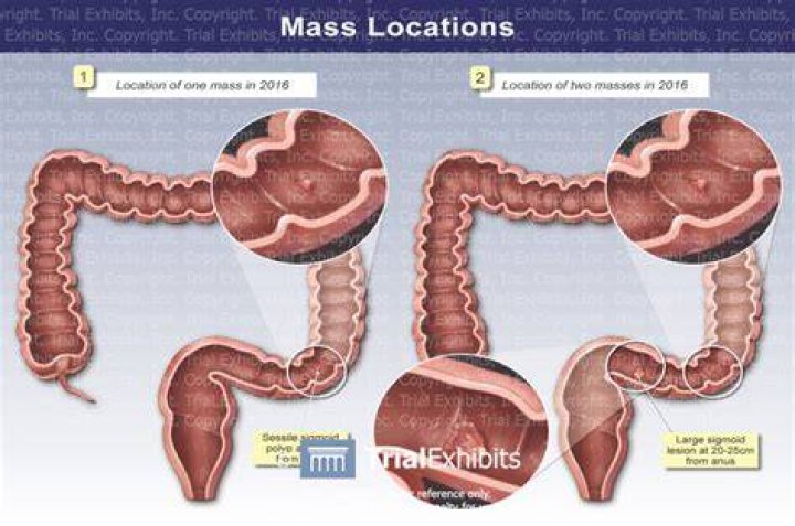 What is considered a large colon mass?
