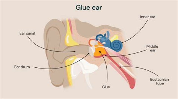 What is glue ear child?