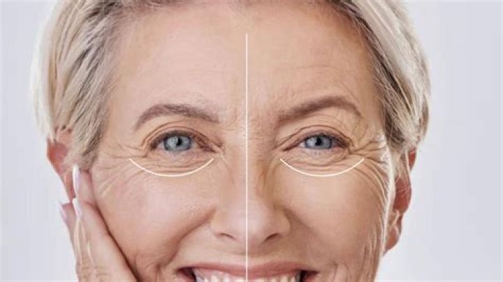 What is good for under eye wrinkles?