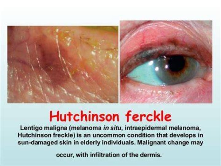 What is Hutchinson's freckle?