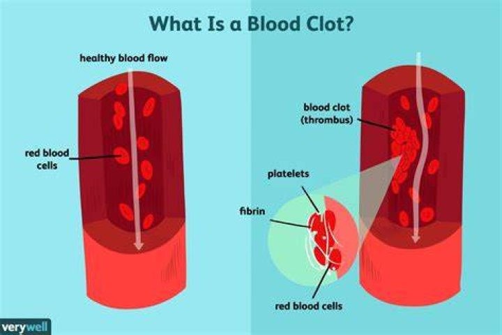 What is often mistaken for a blood clot?