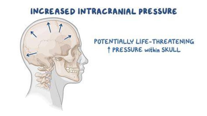 What is one of the earliest signs of increased intracranial pressure?