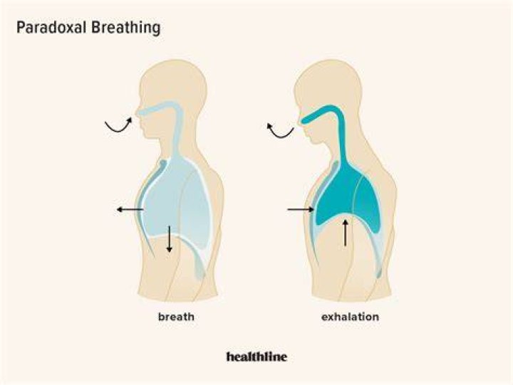What is paradoxical breathing?