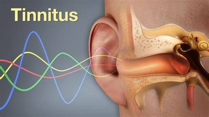 What is severe tinnitus like?