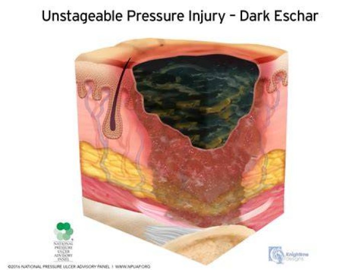 What is skin Eschar?