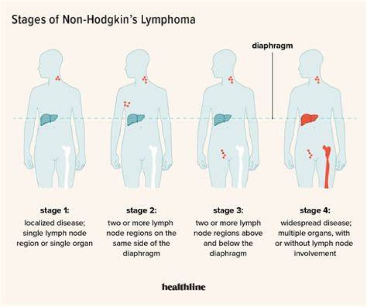 What is Stage 1 Non Hodgkins?