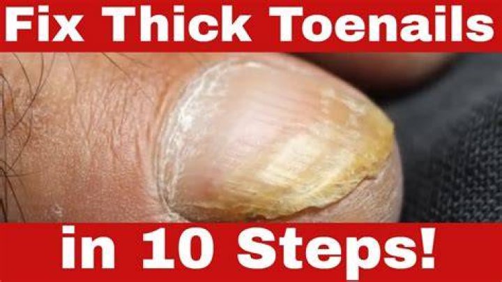 What is the best cure for thick toenails?