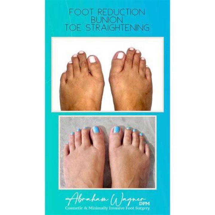 What is the Cinderella procedure?