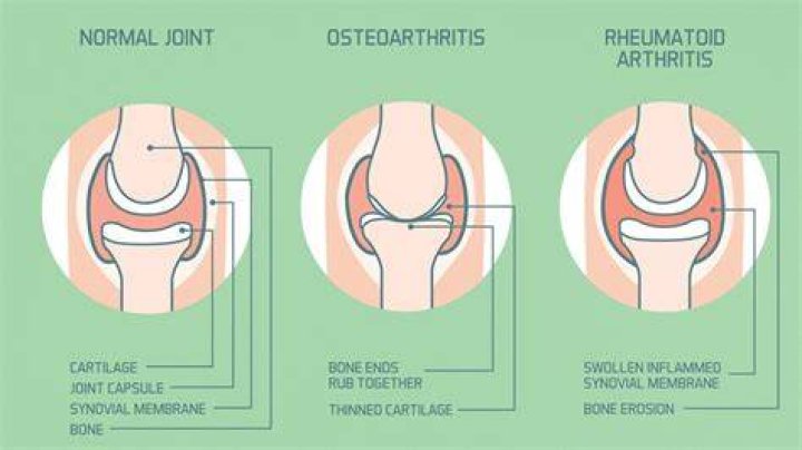 What is the difference between joint pain and arthritis?