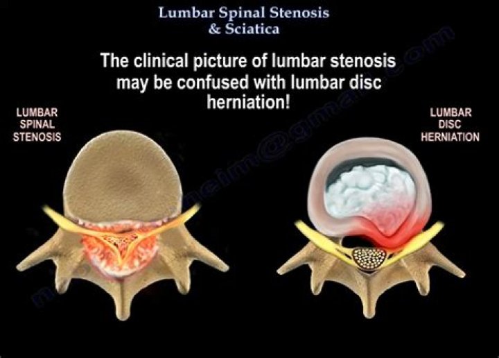 What is the difference between spinal stenosis and lumbar stenosis?