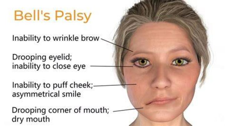 What is the fastest way to cure Bell's palsy?
