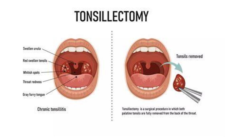 What is the fastest way to recover from a tonsillectomy?