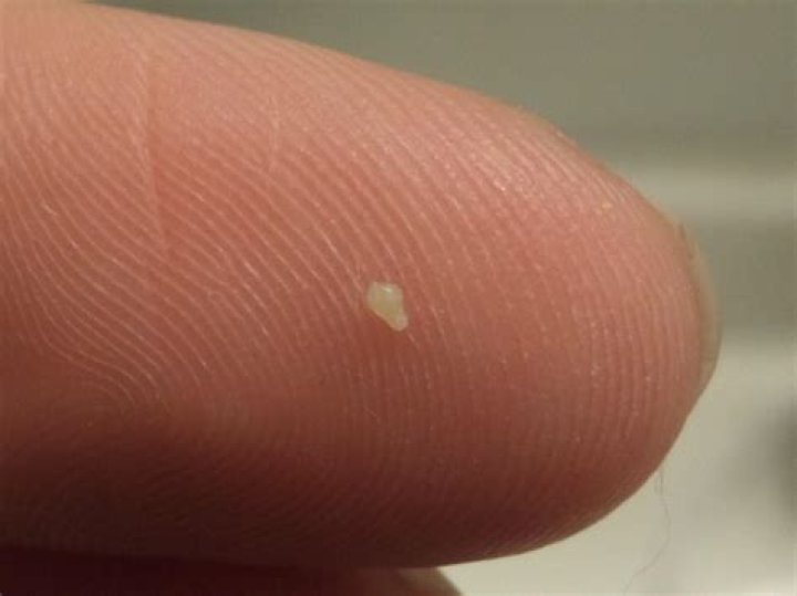 What is the hard seed that comes out of a pimple?