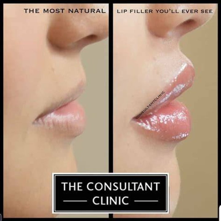 What is the most natural filler?