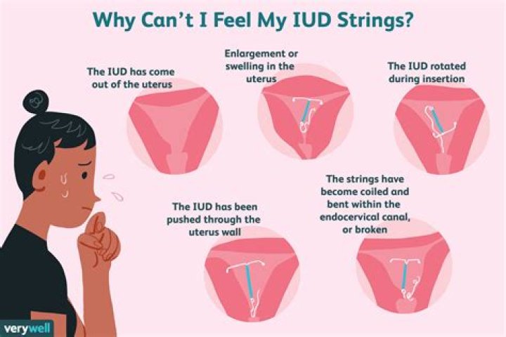 What is the safest IUD?