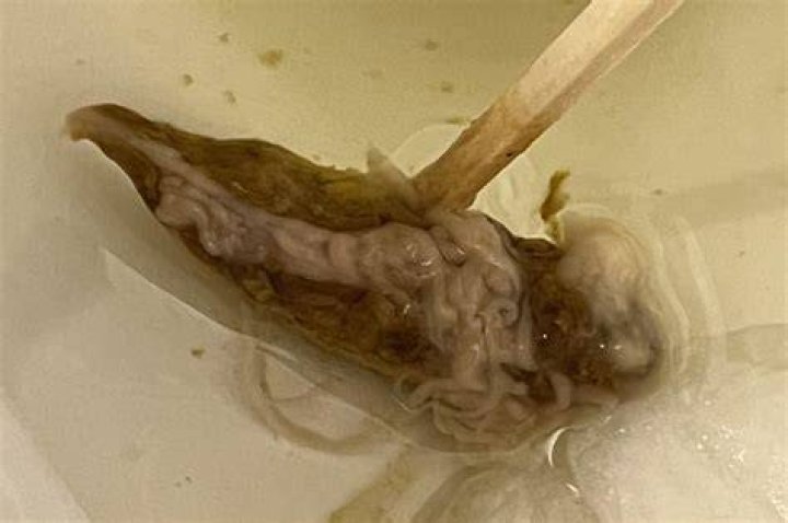 What is the white stringy stuff in my poop?