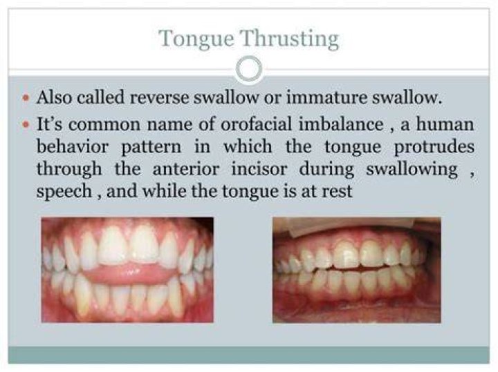 What is tongue thrusting in adults?