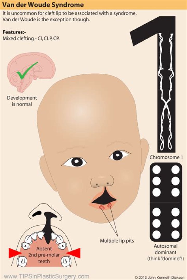 What is van der Woude syndrome?