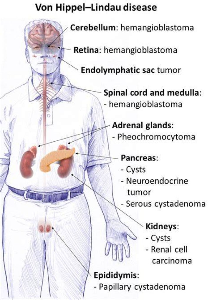 What is Von Hippel Lindau disease?