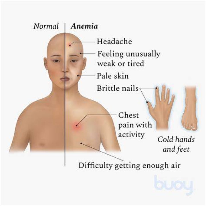 What it feels like to be anemic?