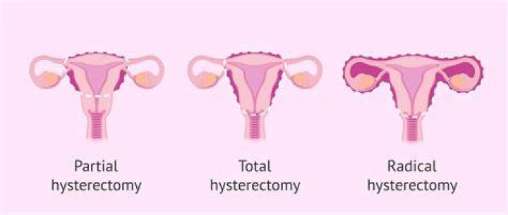 What kind of scar do you get from a hysterectomy?