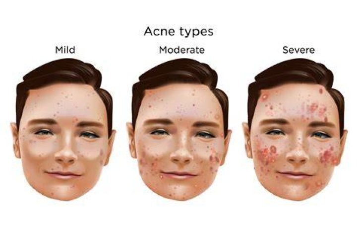 What nationality gets the most acne?