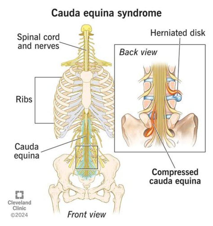 What nerves cause cauda equina?
