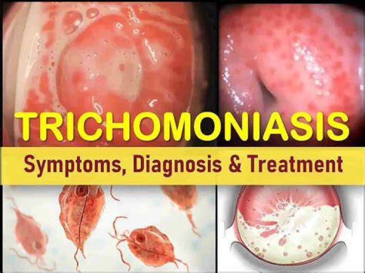 What organs does trichomoniasis affect?