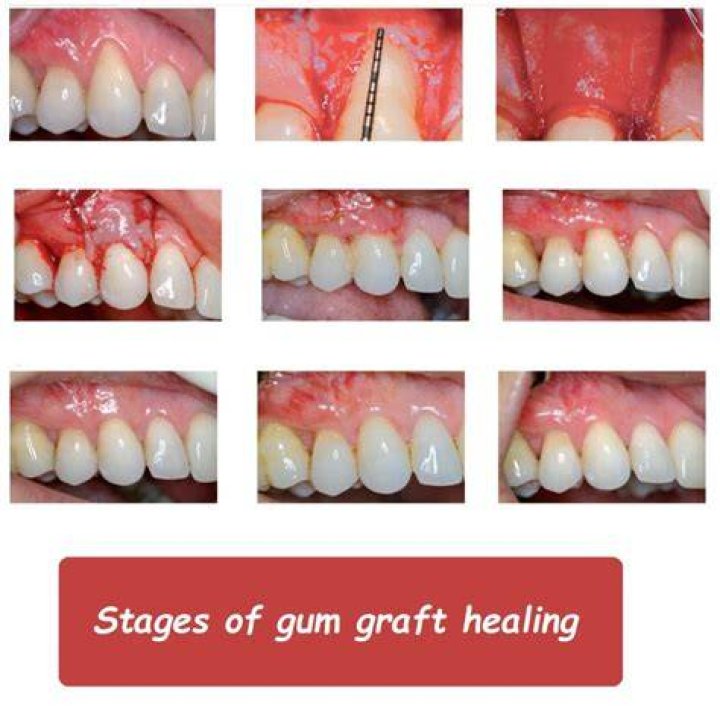 What should a healing gum graft look like?