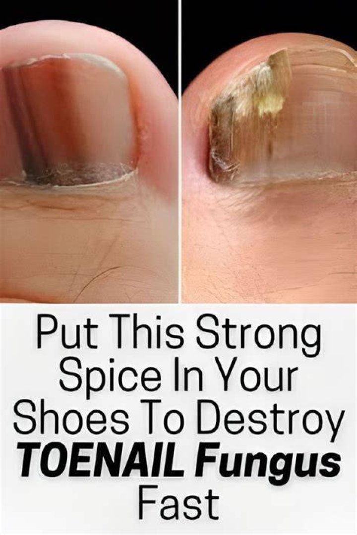 What spice fixes toenail fungus?