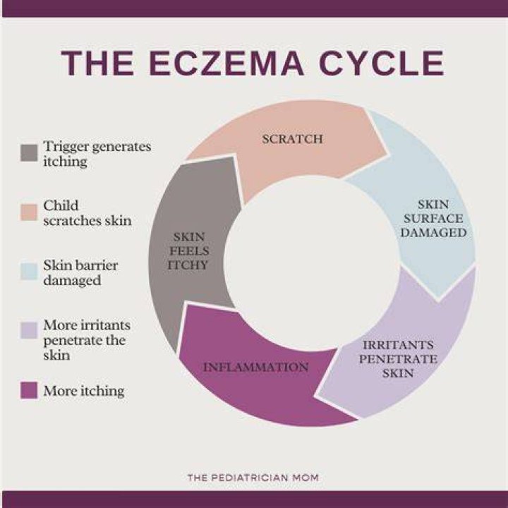 What triggers itchy eczema?