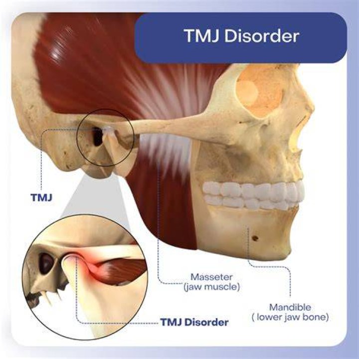 What will a dentist do for TMJ?