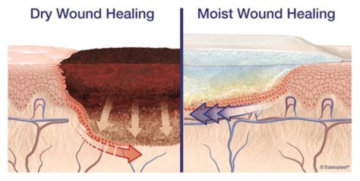 What wound takes longer to heal?