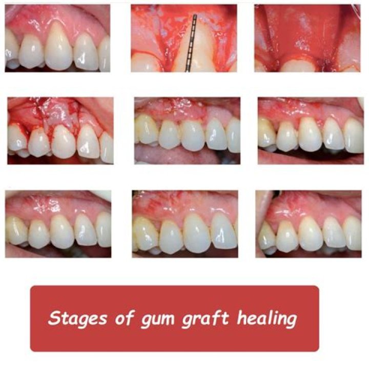 When can I exercise after gum graft?