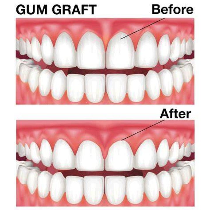 When can I look at my gum graft?