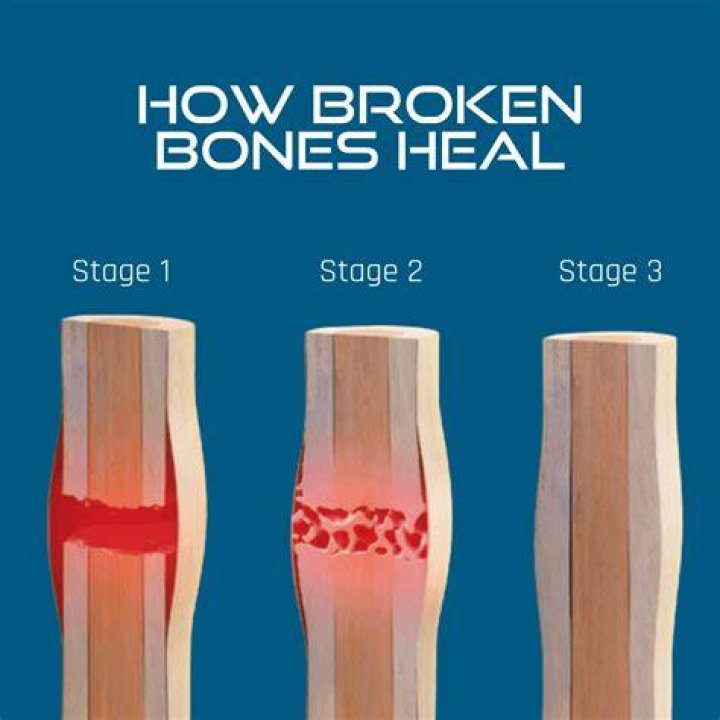 When does a broken bone stop hurting?