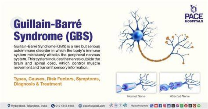 When does Guillain-Barré syndrome occur after Covid?