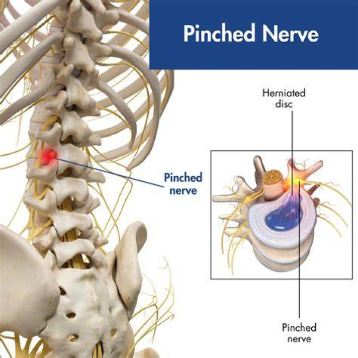 When is a pinched nerve serious?