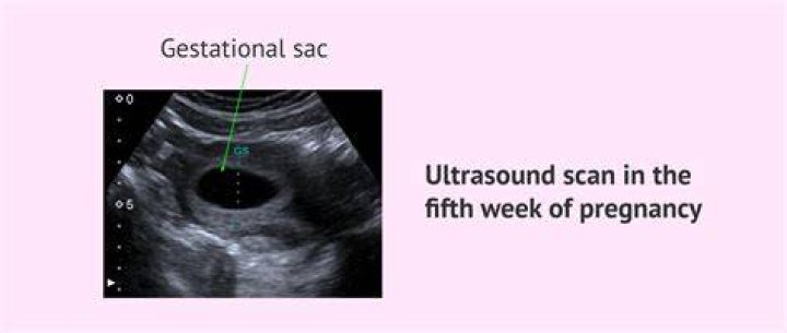 When is the sac visible on ultrasound?