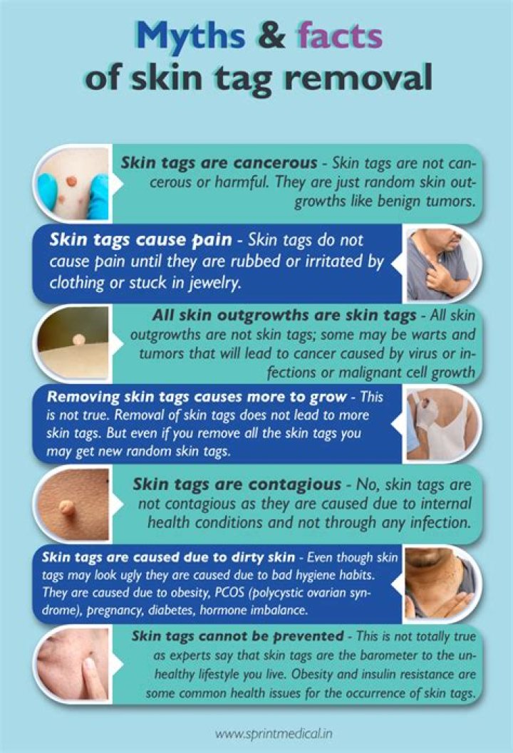 When should I be concerned about a skin tag?