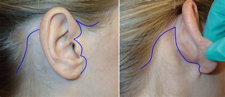 Where are facelift incisions?