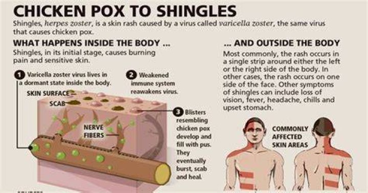 Where did shingles originate from?
