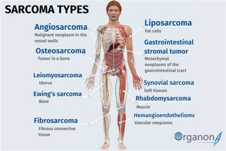 Where do most sarcomas start?
