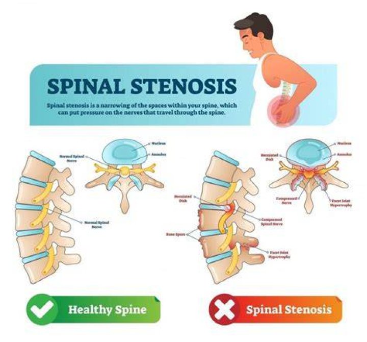 Where do you feel spinal stenosis pain?