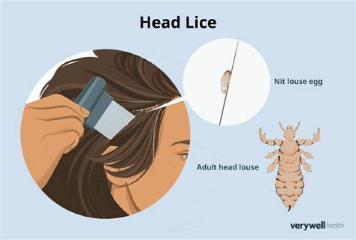 Where does lice usually start?