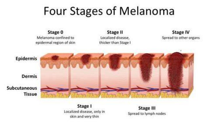 Where does scalp melanoma spread first?