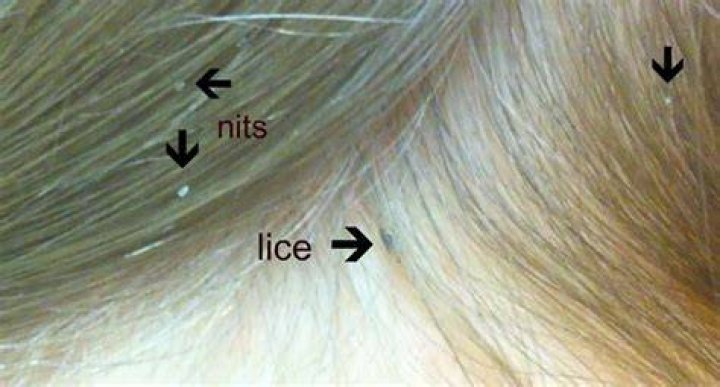 Where does your head itch when you have lice?