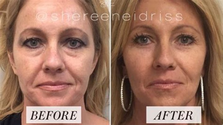 Where is the safest place to get fillers?