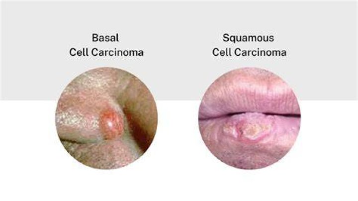 Which grows faster basal cell or squamous cell carcinoma?