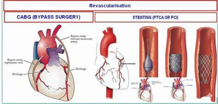 Which is better bypass or stent?